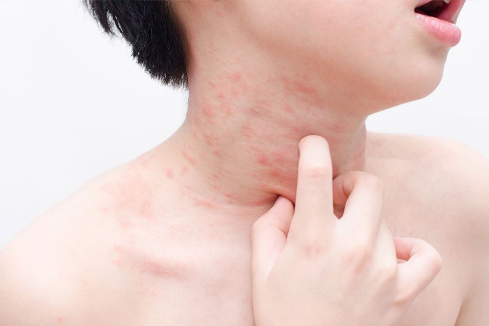 adult heat rash on neck